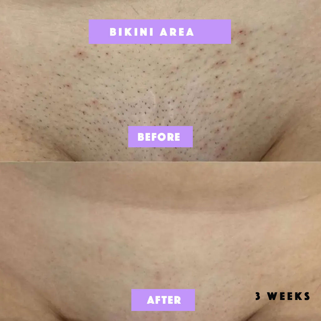 Risen-Smooth – From Ingrown to Smooth Treatment -100% Natural Care for Bumps, Redness & Dark Spots