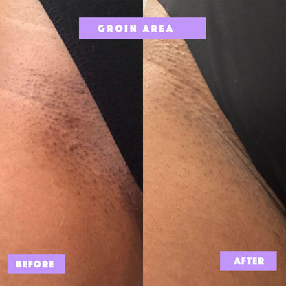 Risen-Smooth – From Ingrown to Smooth Treatment -100% Natural Care for Bumps, Redness & Dark Spots