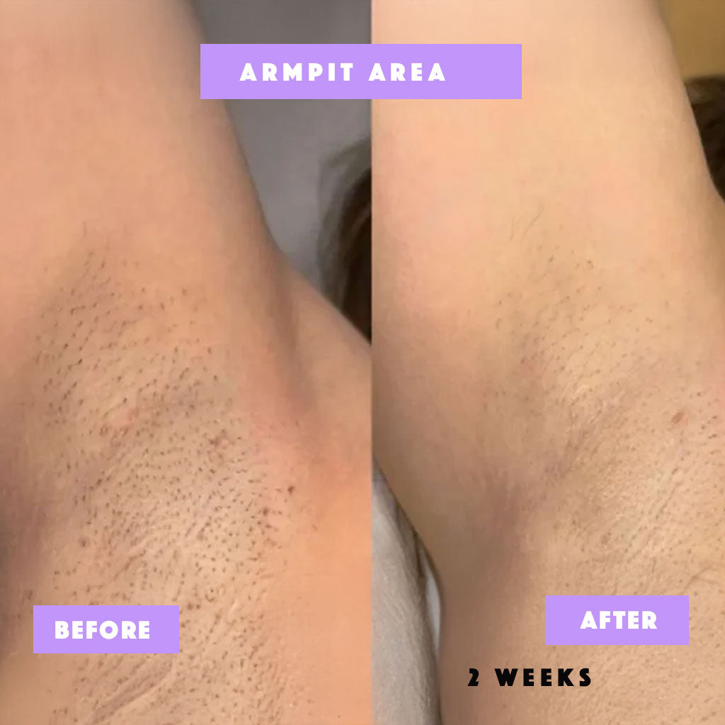 Risen-Smooth – From Ingrown to Smooth Treatment -100% Natural Care for Bumps, Redness & Dark Spots