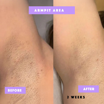 Risen-Smooth – From Ingrown to Smooth Treatment -100% Natural Care for Bumps, Redness & Dark Spots