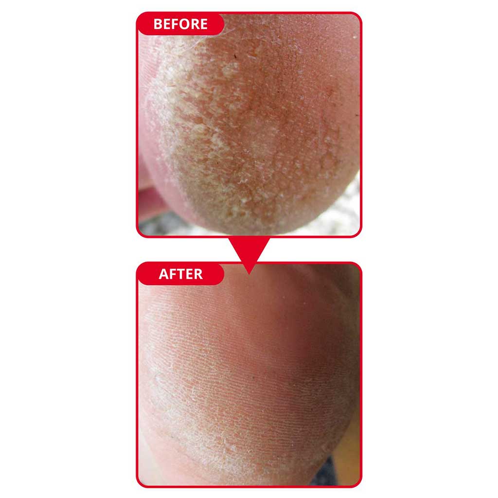 Callus Remove for Diabetic Foot  - The Safest & Effective Callus Solution for Diabetic Foot!