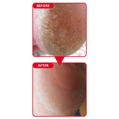 Callus Remove for Diabetic Foot  - The Safest & Effective Callus Solution for Diabetic Foot!