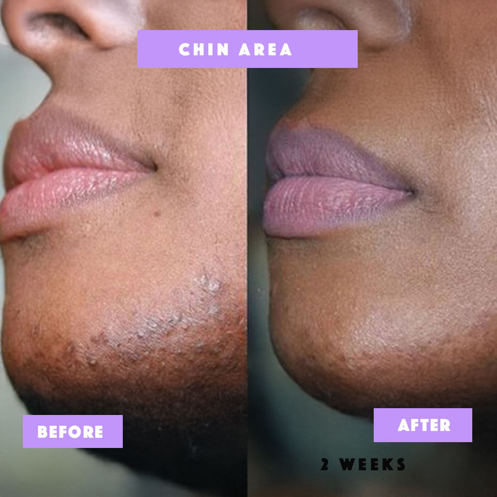 Risen-Smooth – From Ingrown to Smooth Treatment -100% Natural Care for Bumps, Redness & Dark Spots