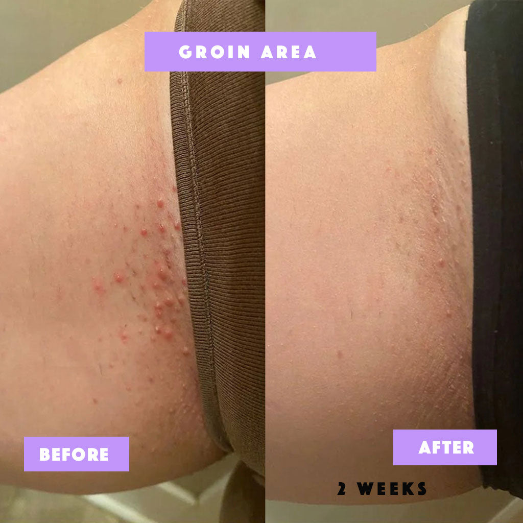 Risen-Smooth – From Ingrown to Smooth Treatment -100% Natural Care for Bumps, Redness & Dark Spots